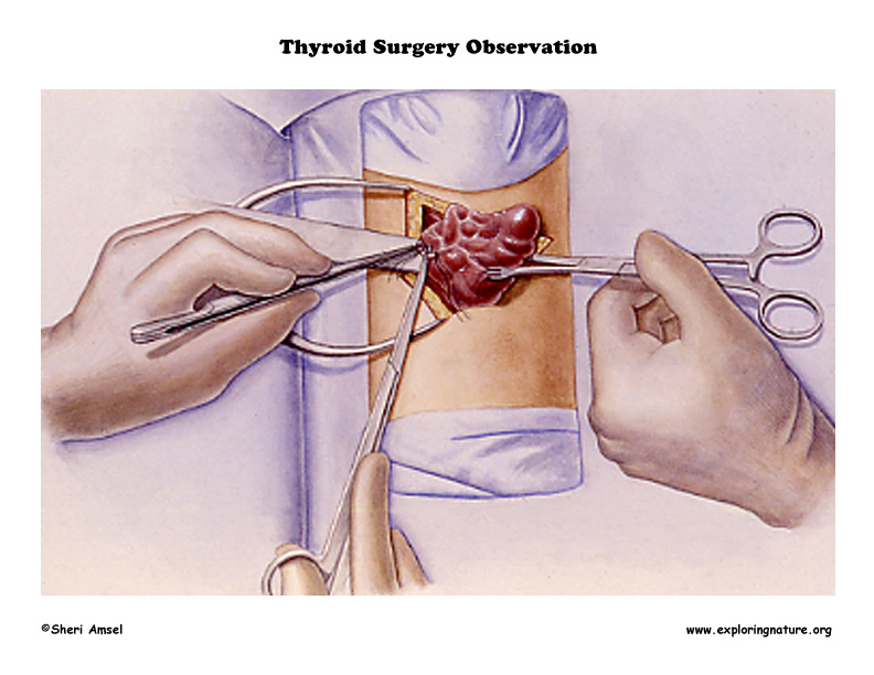 Thyroid Surgery
